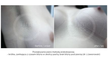 Powiększenie piersi implantami - przed i po