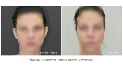 Korekta uszu, przed i po zabiegu (Timeless - dr J.Jaworowski)
