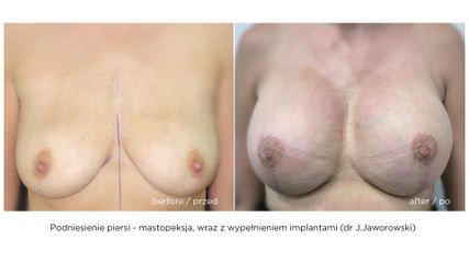 Podniesienie piersi wraz z implantam - przed i po zabiegu (Timeless - dr J.Jaworowski)