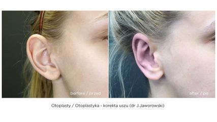 Korekta uszu, przed i po zabiegu (Timeless - dr J.Jaworowski)