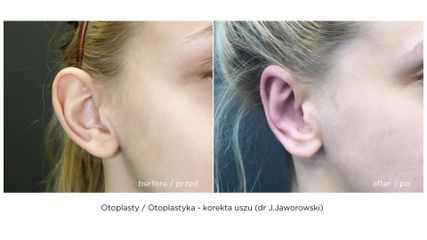 Korekta uszu - przed i po