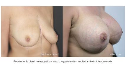 Mastopeksja i powiększenie implantami - przed i po zabiegu (Timeless - dr J.Jaworowski)