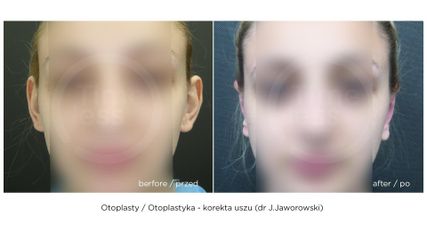Korekta uszu, przed i po zabiegu (Timeless - dr J.Jaworowski)