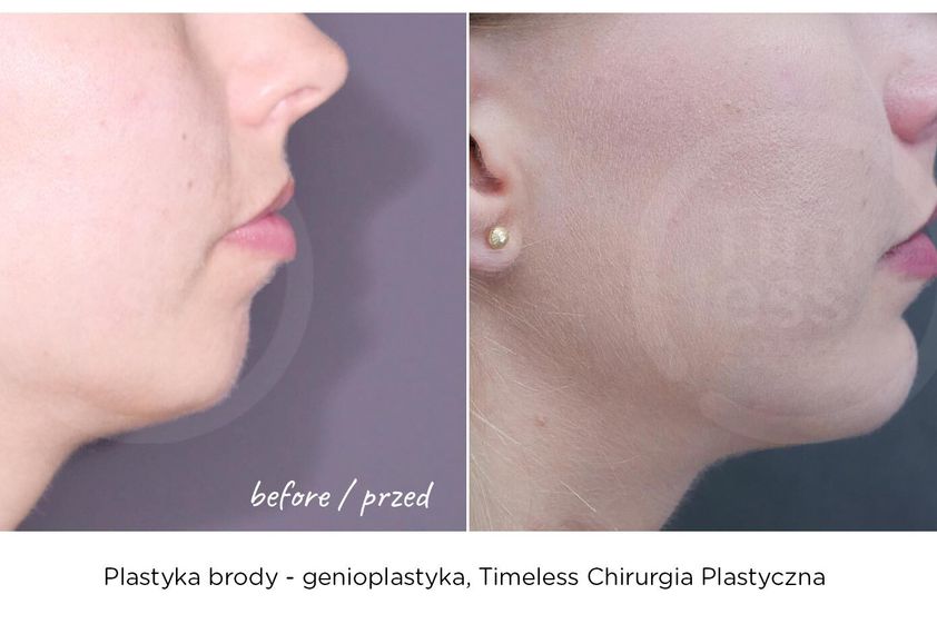 Plastyka brody przed i po - 809366
