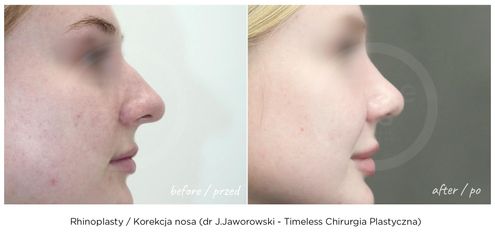 Korekcja nosa - dr Janusz Jaworowski