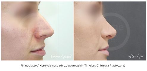 Korekcja nosa - dr Janusz Jaworowski