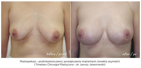 Mastopeksja - Lek. med. Janusz Jaworowski