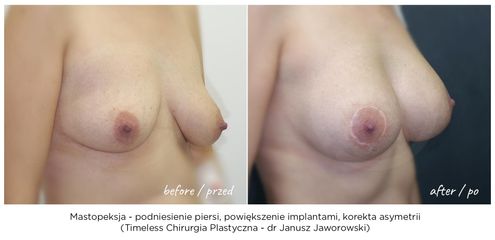 Mastopeksja - Lek. med. Janusz Jaworowski