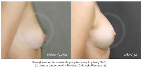 Powiększanie biustu - Lek. med. Janusz Jaworowski