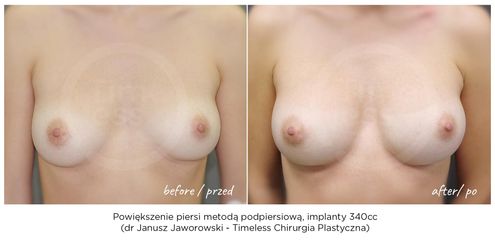 Powiększanie biustu - Lek. med. Janusz Jaworowski