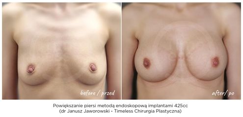 Powiększanie piersi implantami metodą endoskopową - Lek. med. Janusz Jaworowski