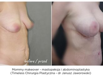Mastopeksja przed i po - 867501