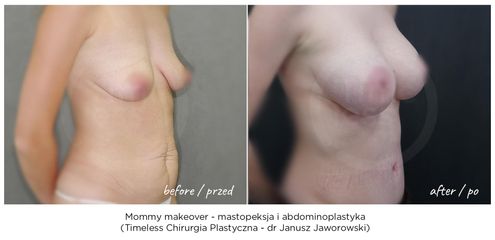 Mommy makeover, przemiana po ciąży - mastopeksja i miniabdominoplastyka