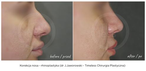 Korekcja nosa - rhinoplastyka - Lek. med. Janusz Jaworowski