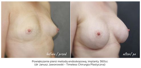 Powiększanie biustu - Lek. med. Janusz Jaworowski