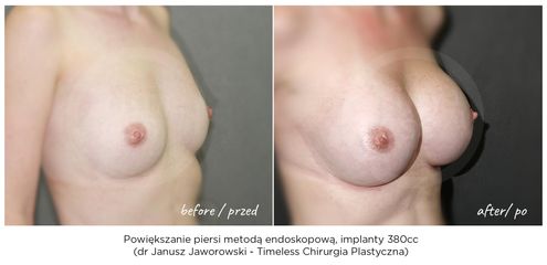 Powiększanie biustu - Lek. med. Janusz Jaworowski
