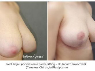 Zmniejszenie biustu przed i po - 869573