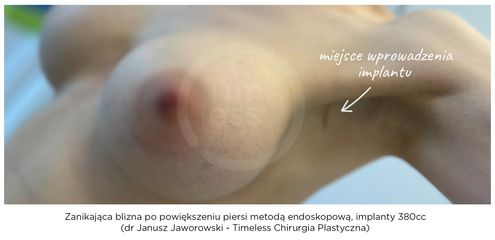 Zanikająca blizna po wprowadzeniu implantu techniką endoskopową