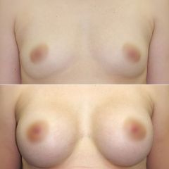 Powiększanie piersi implantami metodą endoskopową.