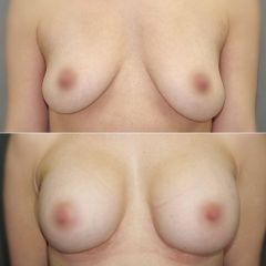 Powiększanie piersi implantami metodą endoskopową.