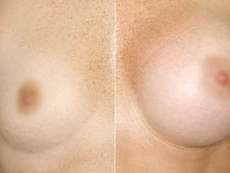 Powiększanie biustu przed i po - 877234