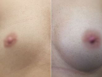 Powiększanie biustu przed i po - 877235