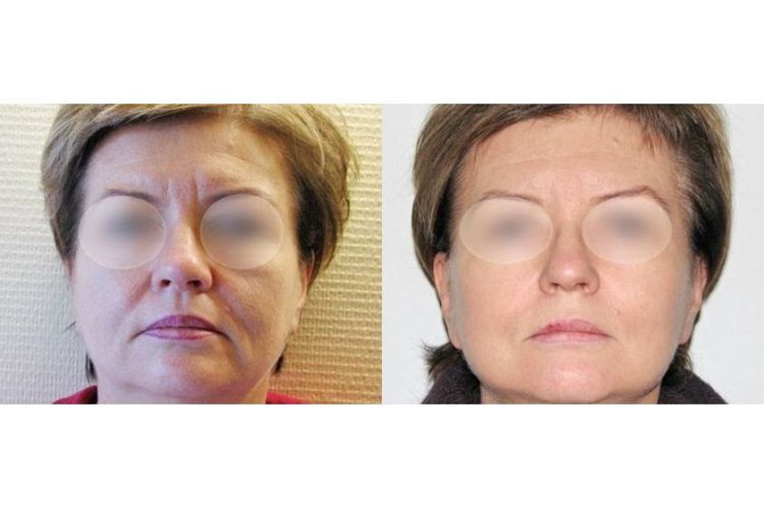 Anti-aging przed i po - 685169