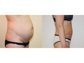 Abdominoplastyka - przed i po