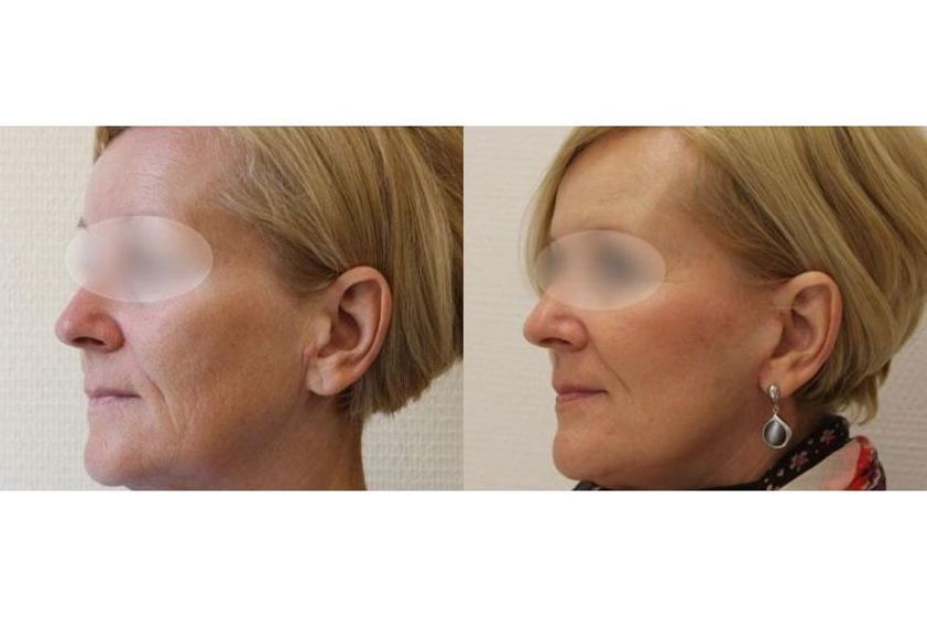 Anti-aging przed i po - 685289