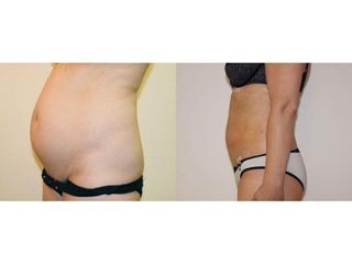 Abdominoplastyka - przed i po