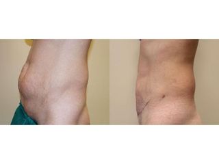 Abdominoplastyka - przed i po