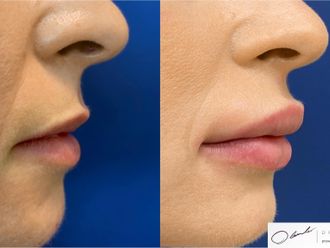 Lip Lift przed i po - 788749
