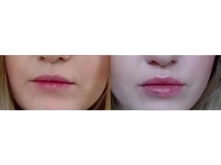 Przed i po - powiększanie i modelowanie ust
