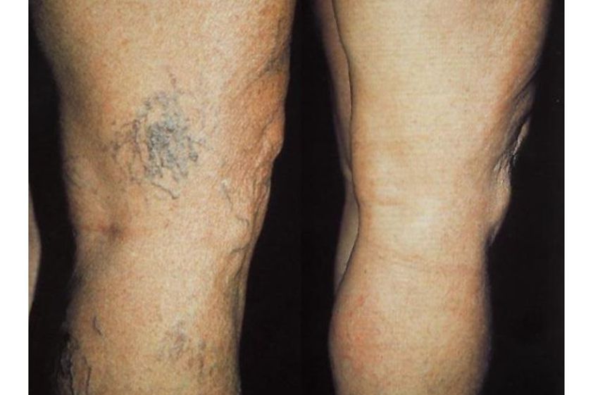 Skleroterapia przed i po - 688422