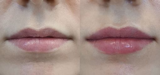 Modelowanie ust kwasem hialuronowym - Ruczaj Clinic