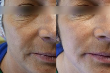 Odmładzanie twarzy kwasem hialuronowym - Ruczaj Clinic
