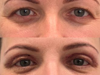 Blefaroplastyka przed i po - 872151