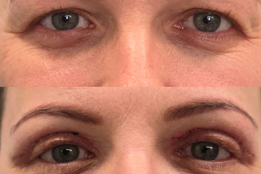 Blefaroplastyka przed i po - 872151