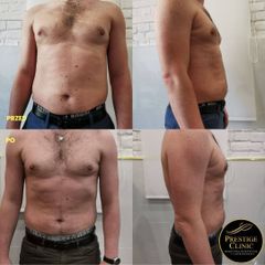 Kriolipoliza - Prestige Clinic Medycyna Estetyczna i Laseroterapia