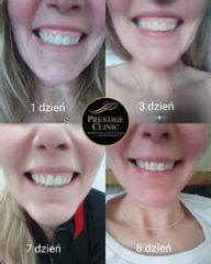 Gummy smile - Prestige Clinic Medycyna Estetyczna i Laseroterapia