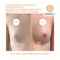 powiększenie piersi - implanty - dr joanna wiśniewska Goryń Formmed