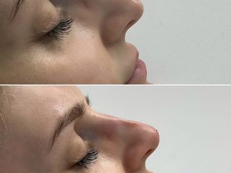 Korekta nosa kwasem hialuronowym przed i po - 877030