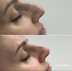 Korekta kształtu nosa kwasem hialuronowym