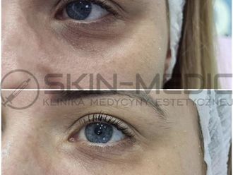 Mezoterapia igłowa przed i po - 877031