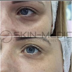 Stymulatory tkankowe podane pod oczy. Biorewitalizacja skóry pod oczami