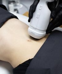 Zabieg HIFU na ciało wykonany w klinice Skin-Medic w Poznaniu