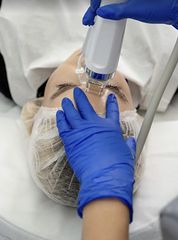 Radiofrekwencja mikroiglowa - usuwanie przebarwień