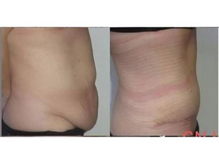 Abdominoplastyka - efekty
