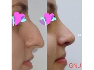 Korekta nosa - efekty