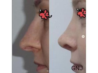Operacja plastyczna nosa - efekty